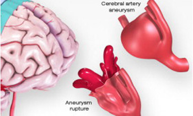 brain aneurysm