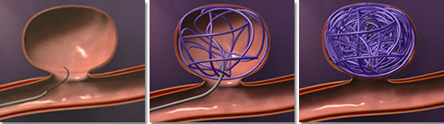 endovascular