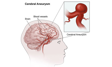 brain aneurysm