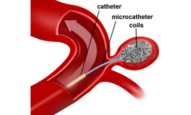 brain aneurysm